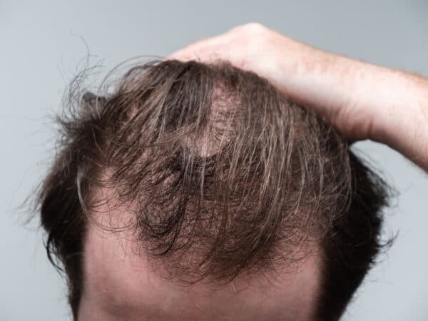 what causes hair loss