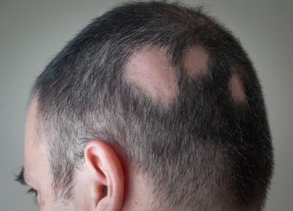 alopecia hair loss