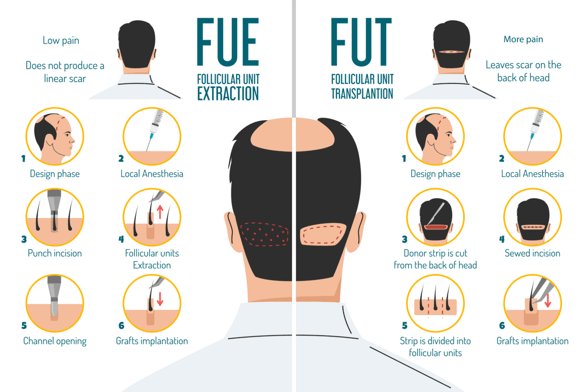fue vs fut hair transplant infographic