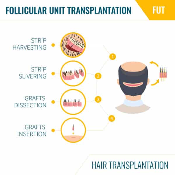 FUT hair transplant
