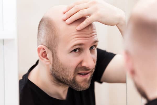 permanent hair loss