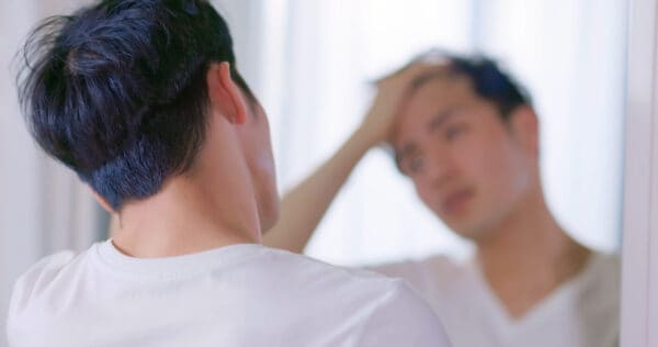 hair loss in young men