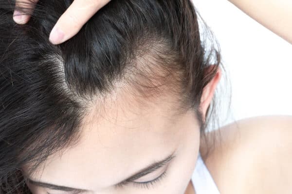 female pattern hair loss