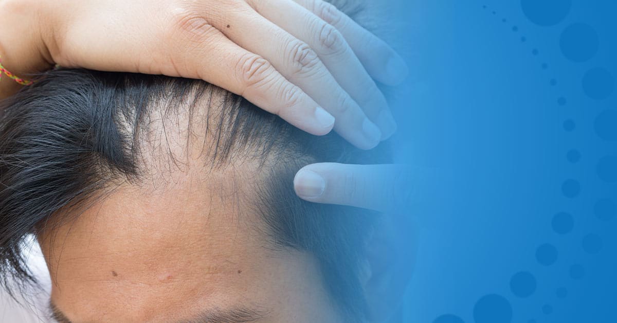 Hair Loss Myths