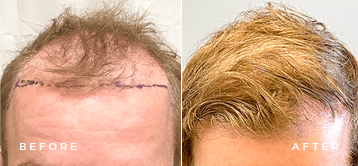 hair replacement before and after
