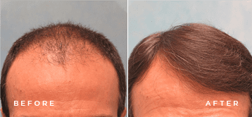 fue transplant before and after