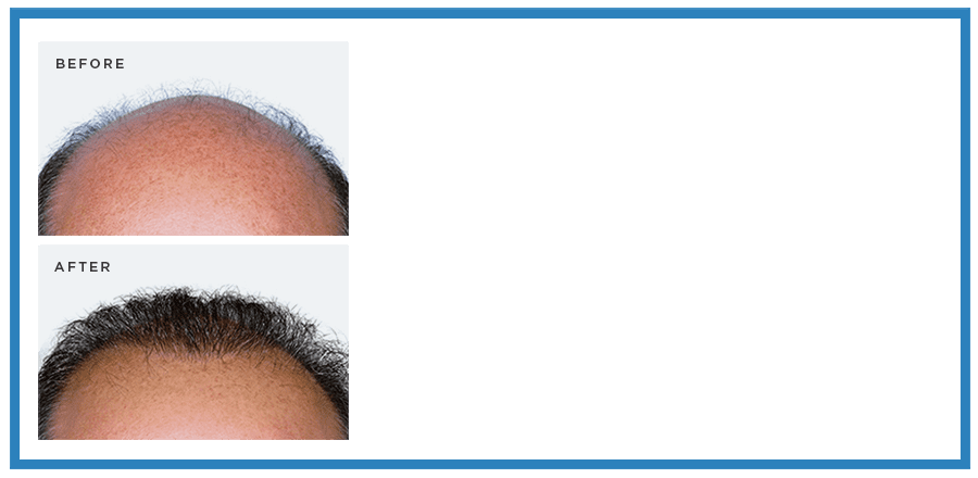 FUE hair transplant before and after