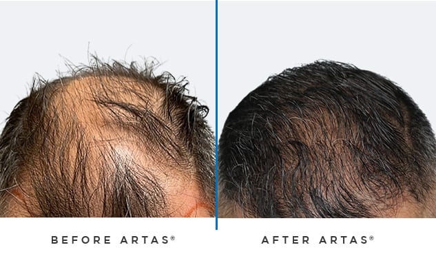 ARTAS hair transplant before and after