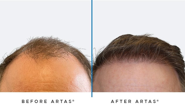 artas before and after