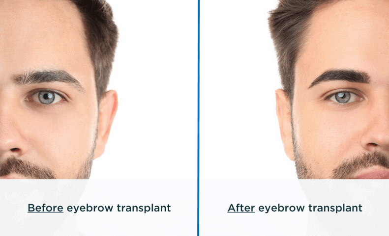 eyebrow transplant before and after