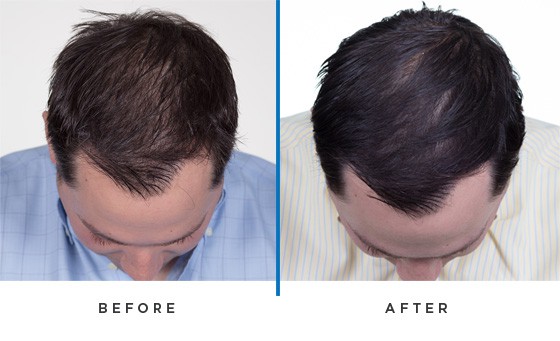 ARTAS hair transplant before and after