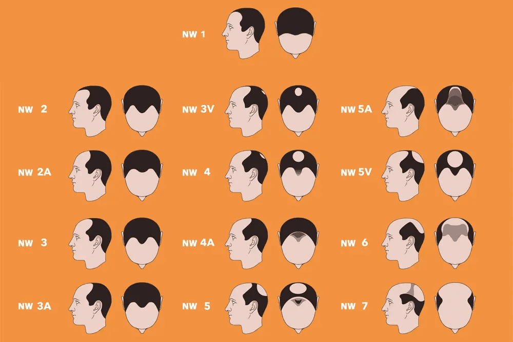 norwood hair loss diagram